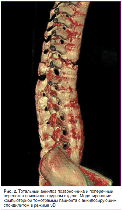 Рис. 2. Тотальный анкилоз позвоночника и поперечный перелом в пояснично-грудном отделе. Моделирование компьютерной томограммы пациента с анкилозирующим спондилитом в режиме 3D