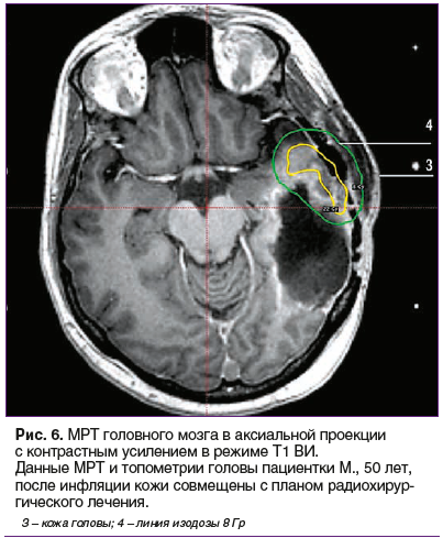 Рис. 6. МРТ головного мозга в аксиальной проекции с контрастным усилением в режиме Т1 ВИ. Данные МРТ и топометрии головы пациентки М., 50 лет, после инфляции кожи совмещены с планом радиохирургического лечения.