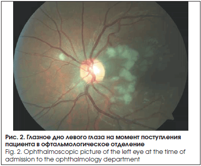 Глазное дно левого глаза на момент поступления пациента в офтальмологическое отделение