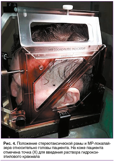 Рис. 4. Положение стереотаксической рамы и МР-локалай- зера относительно головы пациента. На коже пациента отмечена точка (Х) для введения раствора гидрокси- этилового крахмала