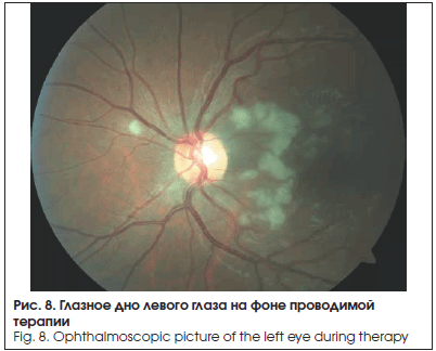 Глазное дно левого глаза на фоне проводимой терапии
