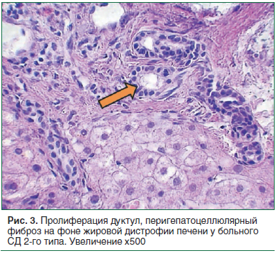 Рис. 3. Пролиферация дуктул, перигепатоцеллюлярный фиброз на фоне жировой дистрофии печени у больного СД 2-го типа. Увеличение х500