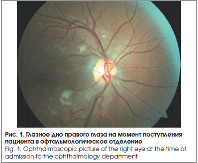 Глазное дно правого глаза на момент поступления пациента в офтальмологическое отделение