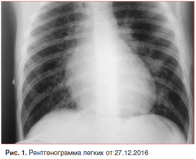Рис. 1. Рентгенограмма легких от 27.12.2016