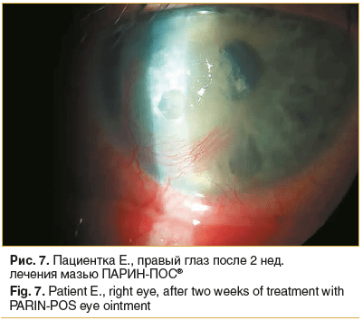 Рис. 7. Пациентка Е., правый глаз после 2 нед. лечения мазью ПАРИН-ПОС®