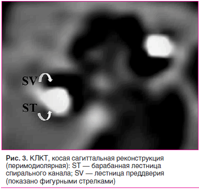 Рис. 3. КЛКТ, косая сагиттальная реконструкция (перимодиолярная): ST — барабанная лестница спирального канала; SV — лестница преддверия (показано фигурными стрелками)