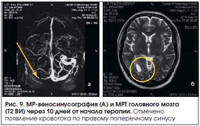 Рис. 9. МР-веносинусография (А) и МРТ головного мозга (Т2 ВИ) через 10 дней от начала терапии.