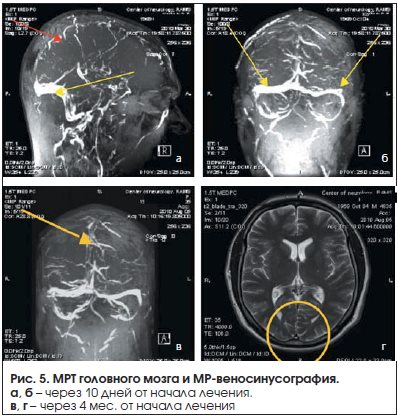 Рис. 5. МРТ головного мозга и МР-веносинусография.