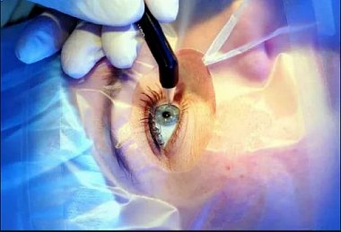 Клинические результаты хирургической резекции склеры у больных с первичной глаукомой